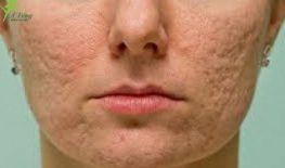 TRỊ SẸO BẰNG LASER FRACTIONAL