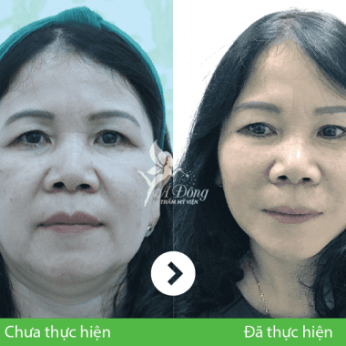Căng Da Mặt Chỉ Collagen Lifting 4D