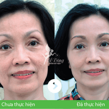 Nâng chân mày phẫu thuật