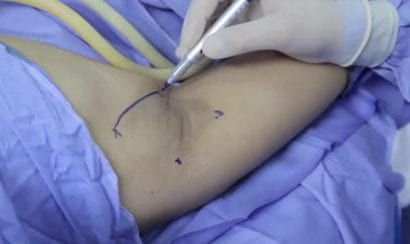 Tiến hành gây tê cục bộ 